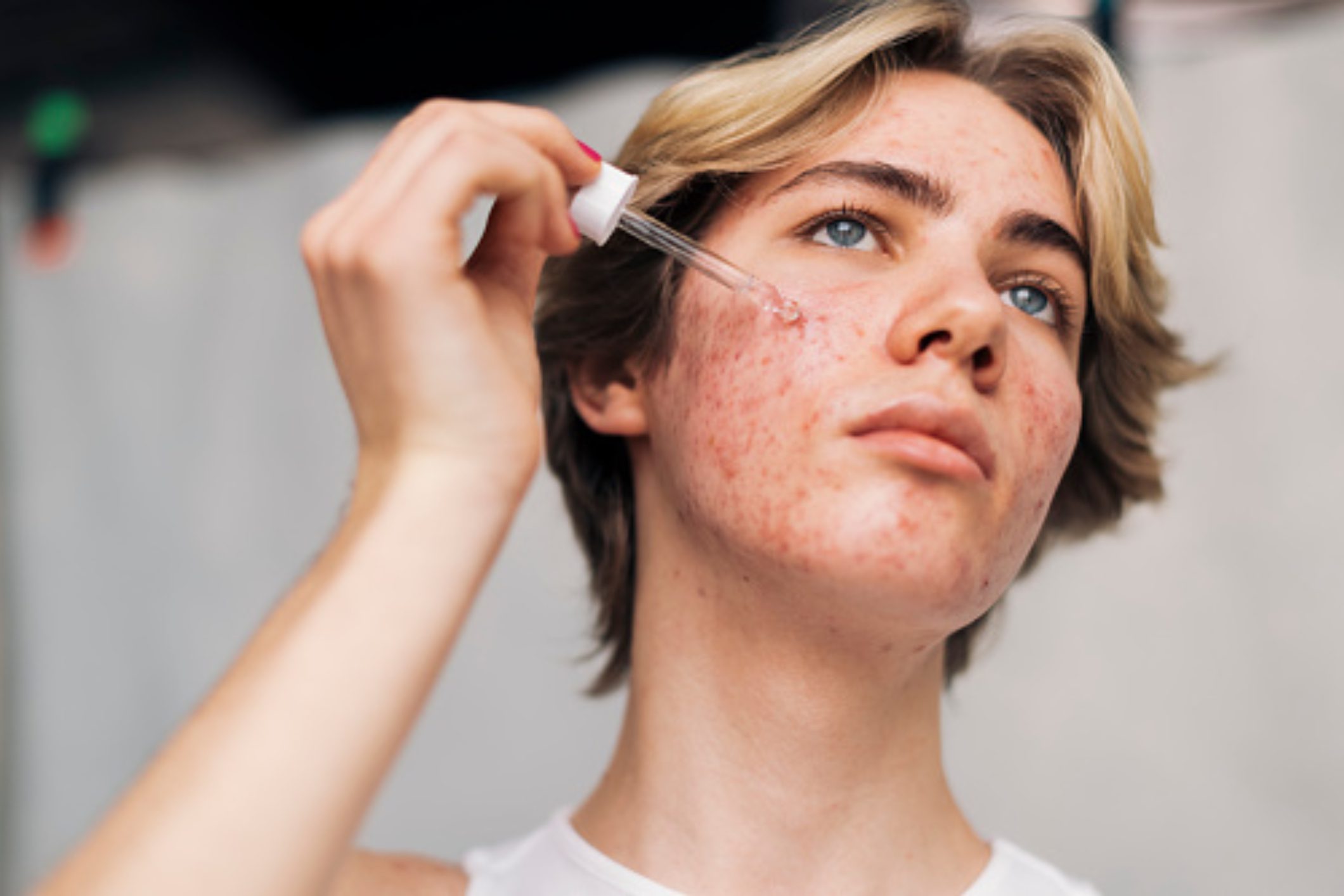 Young woman applying skincare serum to acne-affected face.