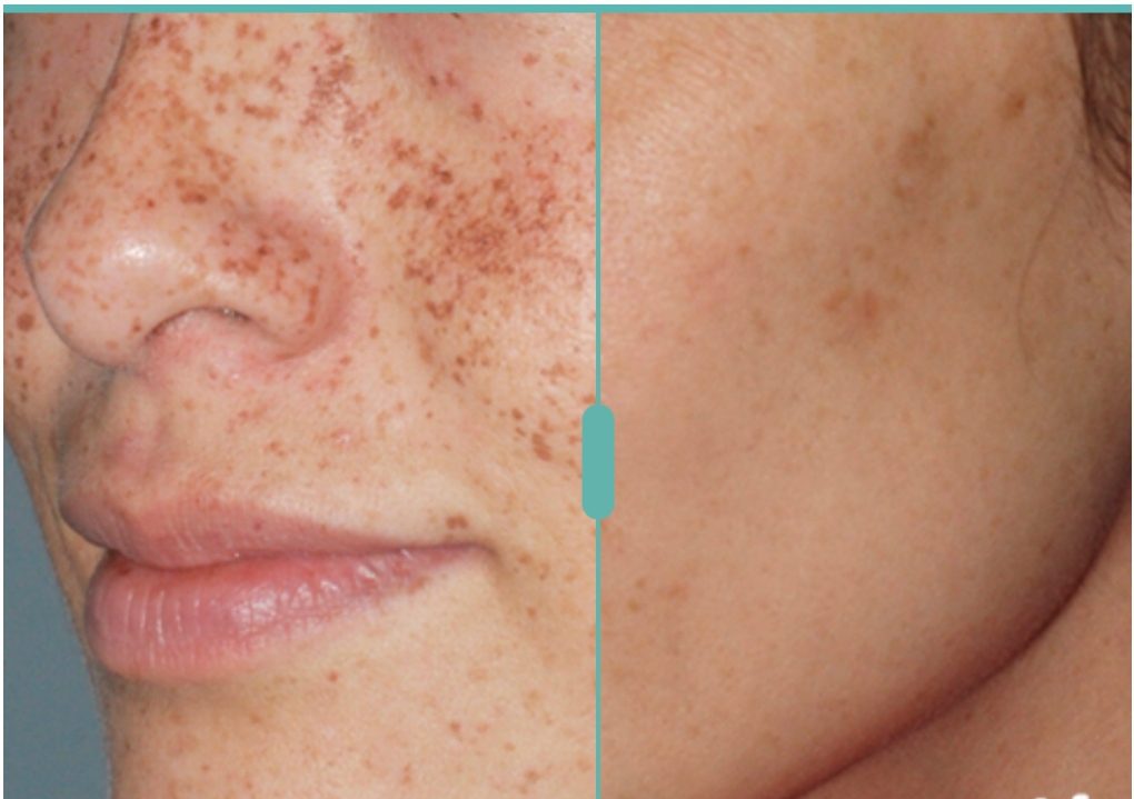 Before and after image showing reduced facial freckles.