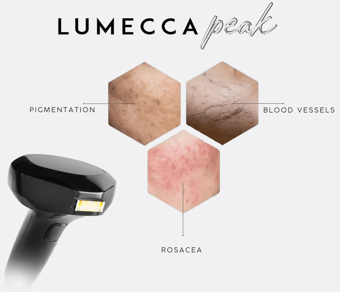 Lumecca Peak device targets pigmentation, blood vessels, and rosacea for clearer skin.