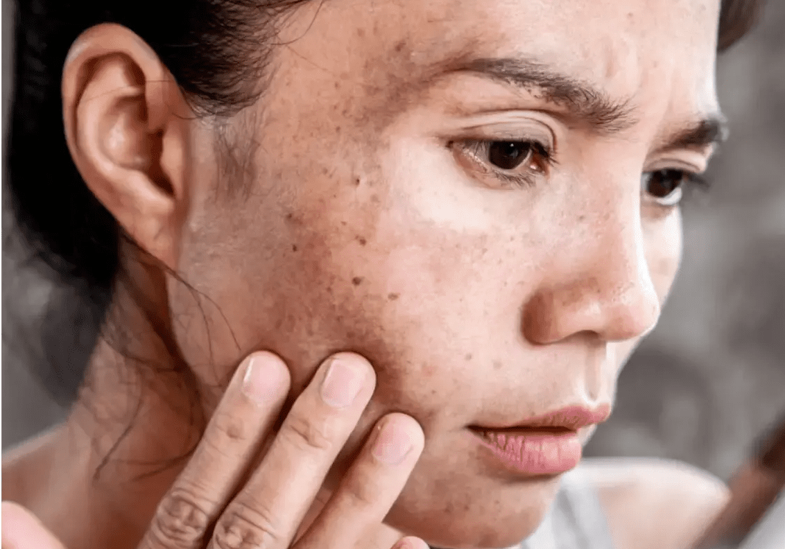 A woman examining her skin closely with concern.